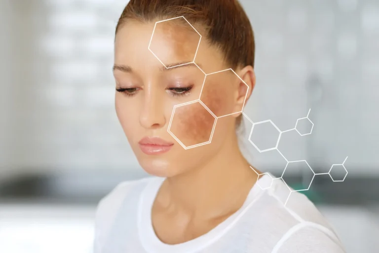 Chemical Peel For Hyperpigmentation