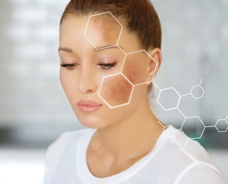 Chemical Peel For Hyperpigmentation