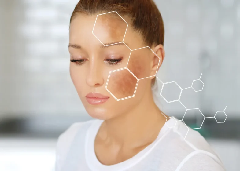 Chemical Peel For Hyperpigmentation