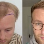 Best Hair Transplat Turkey