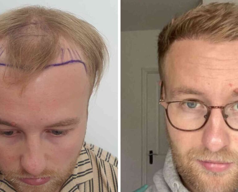Best Hair Transplat Turkey